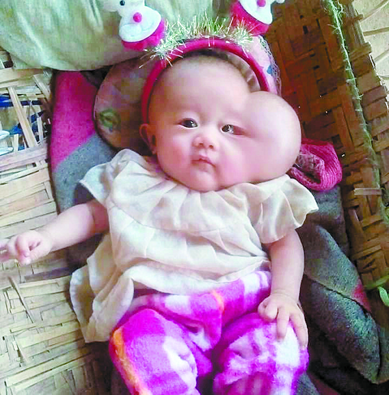 A photo of Christy is taken on her first birthday at her home in Bago, Myanmar. Christy was born with a benign lump on her face, which doctors in Korea removed early November at Bundang Cha Medical Center in Seongnam, Gyeonggi. [BIO PLASTIC SURGERY]