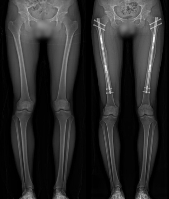  Before and after x-rays of height surgery. The patient has added 6.7 centimeters to height by lengthening the thighs. [DONGHOOD ADVANCED LENGTHENING AND RECONSTRUCTION INSTITUTE]