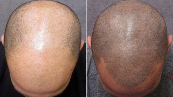 Before, left, and after scalp micropigmentation [ONLINE SCREEN GRAB]