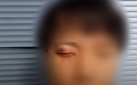 The injured face of the Korean man who was attacked by three Caucasians in Sydney last December [SCREEN CAPTURE]