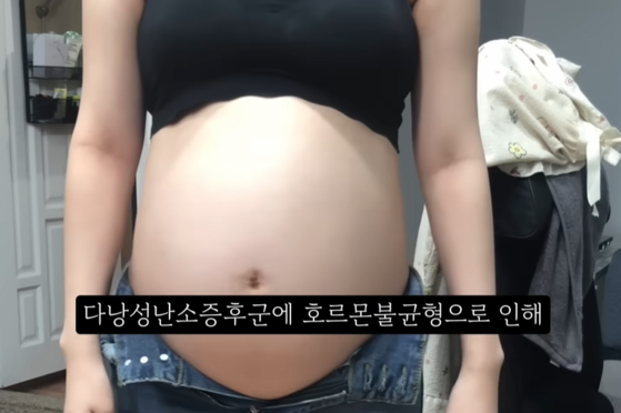 A screen capture image of a video sharing experiences of receiving abortion. A woman shows her floated belly with a subtitle saying that she thought imbalance of her hormones and polycystic ovary syndrome were the cause of her physical change. [SCREEN CAPTURE]