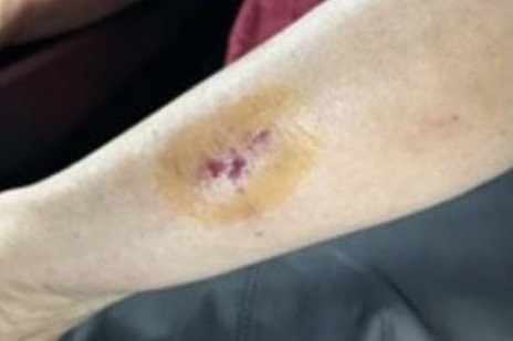 Picture of the assaulted grandmother's bitten arm [SCREEN CAPTURE]