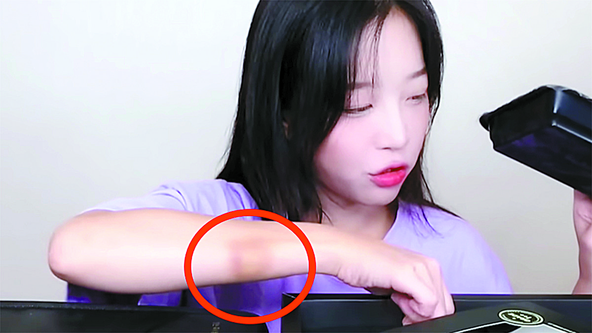 YouTuber Tzuyang displays a bruise on her right arm. [SCREEN CAPTURE]